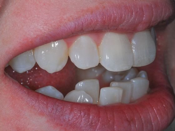 Orthodontics: Case 2 - Before
