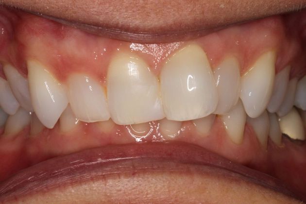 Orthodontics Case 3 - Before