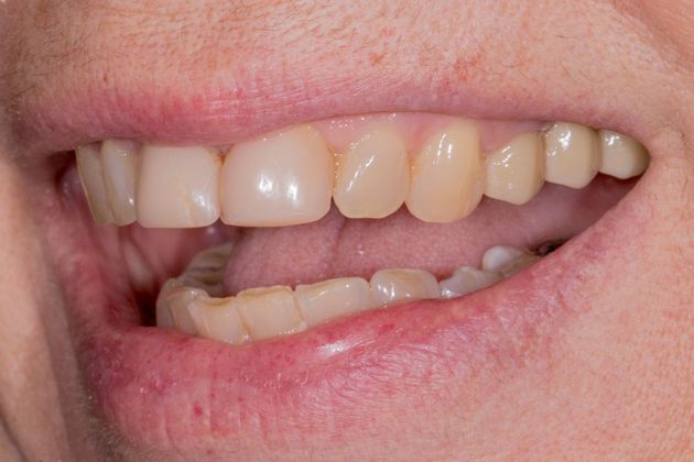 Dental Crowns: Case 2 - Before