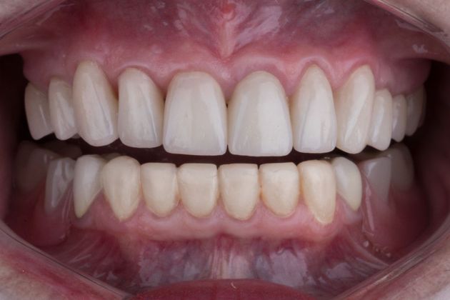 Full Mouth Makeovers: Case 3 - After