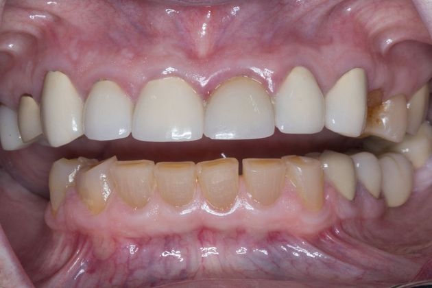 Full Mouth Makeovers: Case 3 - Before