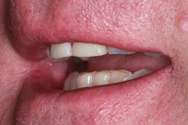 Dental Crowns: Case 3 - Before