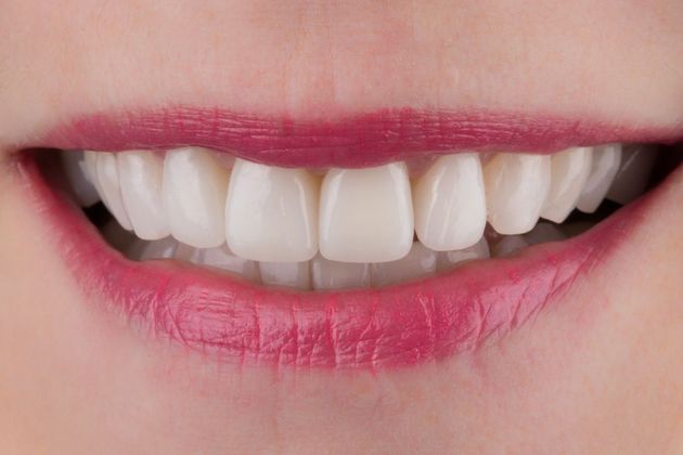 Dental Veneers: Case 1 - After
