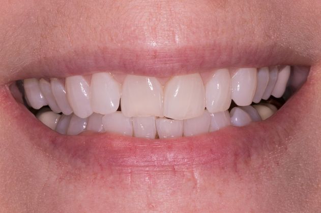 Dental Veneers: Case 1 - Before