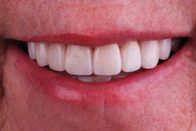 Full Mouth Makeovers: Case 4 - After