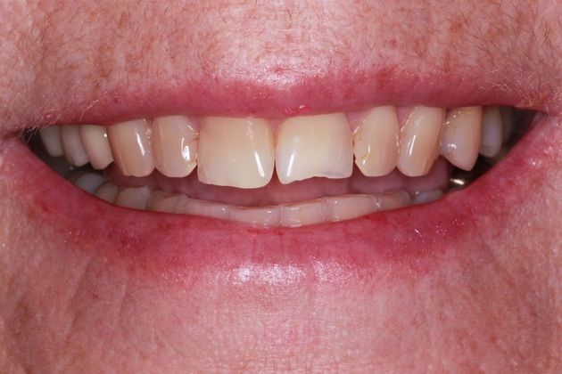 Full Mouth Makeovers: Case 4 - Before