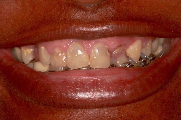 Full Mouth Makeovers: Case 5 - Before