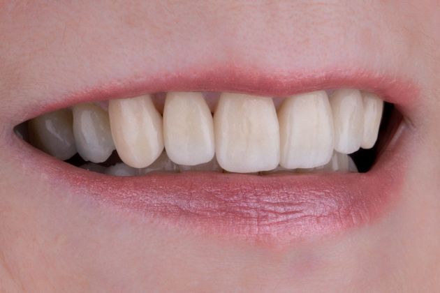 Full Mouth Makeovers: Case 6 - After