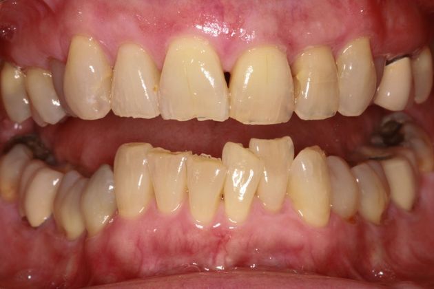 Full Mouth Makeovers: Case 6 - Before