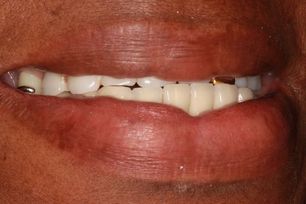 Dentures Case 1 - Before