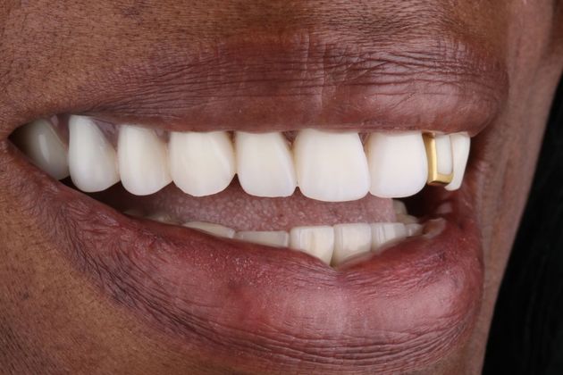 Dentures Case 1 - After