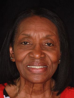 Dentures: Case 1 - Before