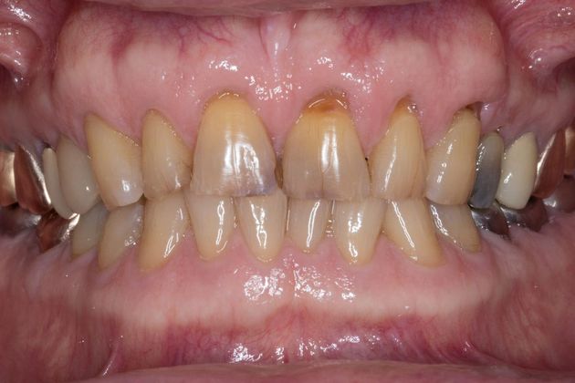 Dental Crowns Case 5 - Before