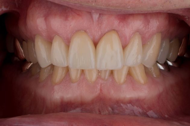 Dental Crowns Case 5 - After