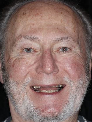 Full Mouth Makeovers: Case 7 - Before