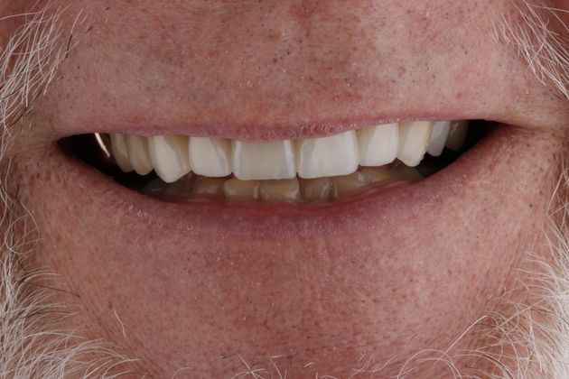 Full Mouth Makeovers: Case 7 - Before