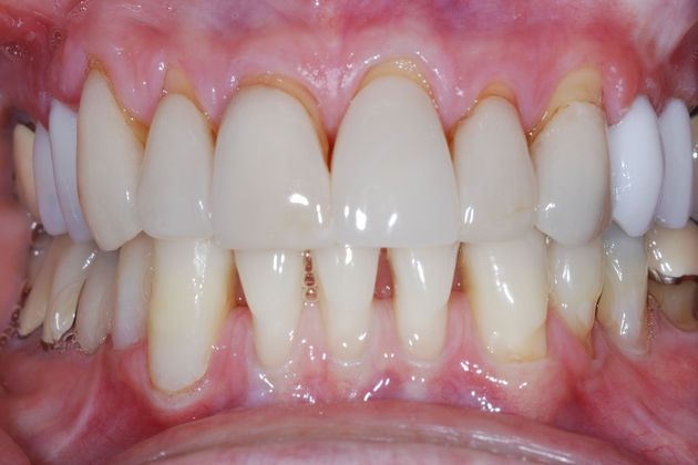 Dental Crowns Case 6 - Before