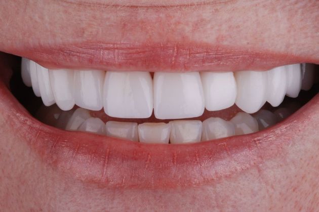 Dental Crowns Case 6 - After