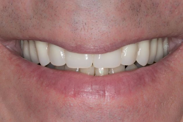 Dentures Case 2 - After