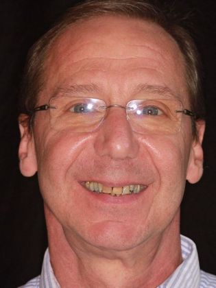 Dentures: Case 2 - Before