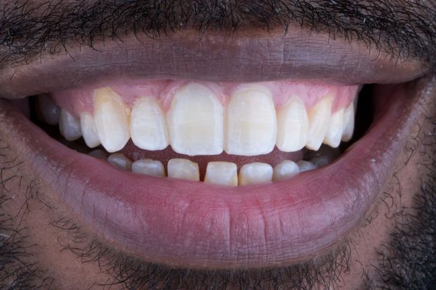 Dental Crowns Case 7 - After