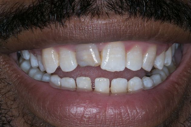 Dental Crowns Case 7 - Before