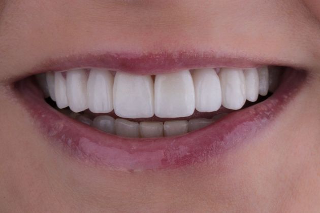 Full Mouth Makeovers: Case 8 - After