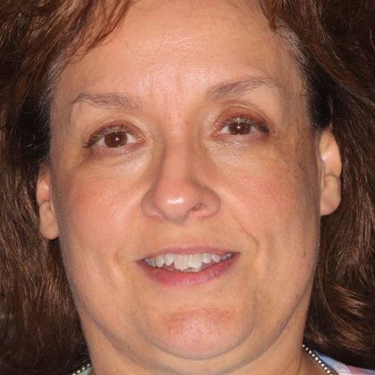 Full Mouth Makeovers: Case 8 - Before