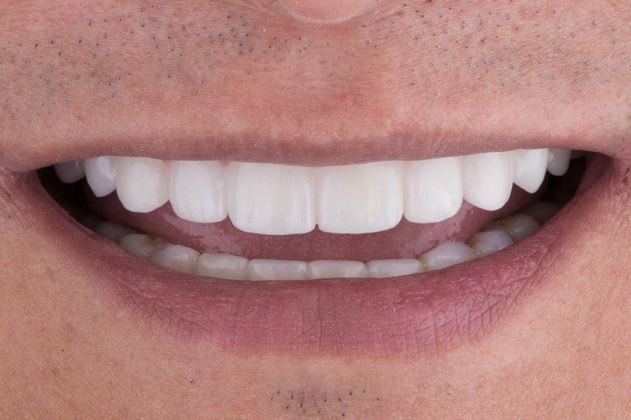 Dental Implants: Case 1 - After