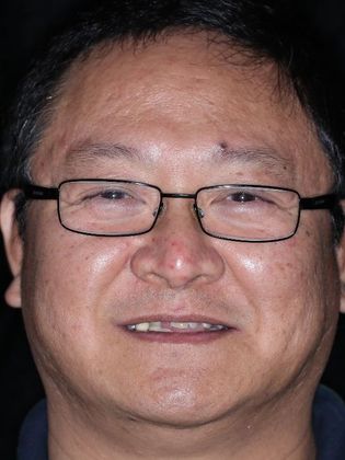 Dental Implants: Case 1 - Before