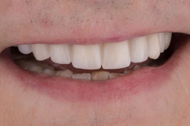 Dental Implants: Case 2 - After