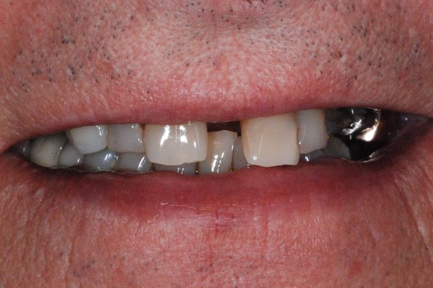 Dental Implants: Case 2 - Before