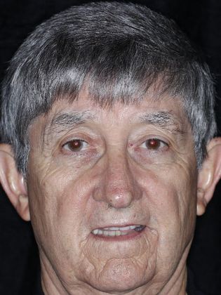 Dental Implants: Case 2 - Before