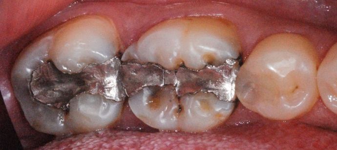Tooth-colored Fillings Case 1 - Before