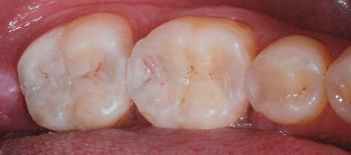 Tooth-colored Fillings Case 1 - After
