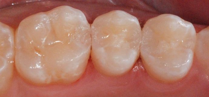 Tooth-colored Fillings Case 2 - After