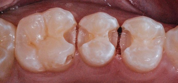 Tooth-colored Fillings Case 2 - Before