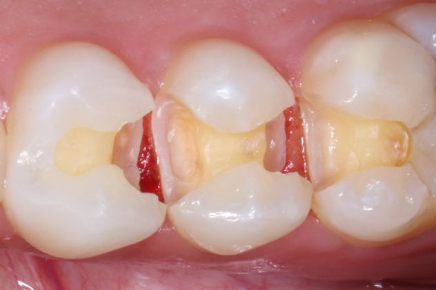 Tooth-colored Fillings Case 3 - Before
