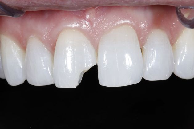 Tooth-colored Fillings Case 4 - Before