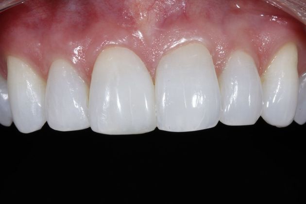 Tooth-colored Fillings Case 4 - After