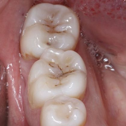 Tooth-colored Fillings Case 5 - Before