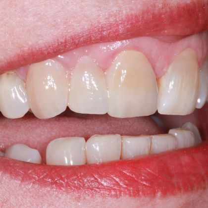 Dental Crowns Case 8 - After