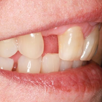 Dental Crowns Case 8 - Before