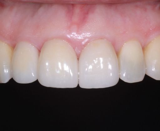 Dental Crowns: Case 9 - After