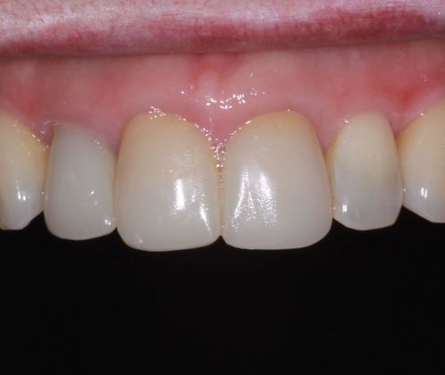 Dental Crowns: Case 9 - Before
