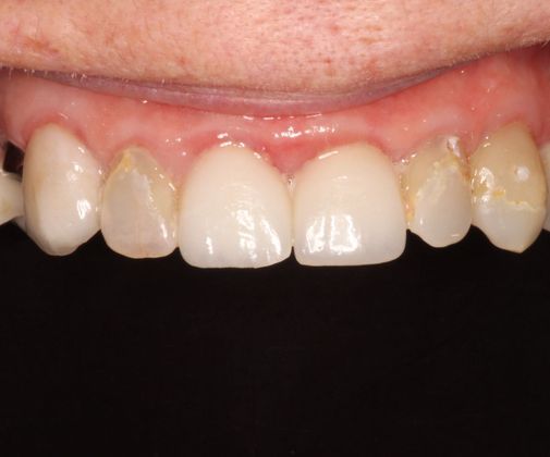 Dental Veneers Case 2 - Before
