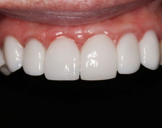 Dental Veneers Case 2 - After