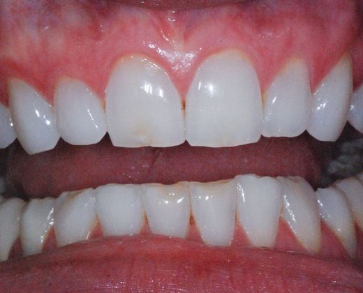 Dental Veneers Case 3 - Before