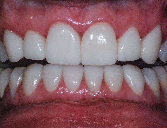 Dental Veneers Case 3 - After