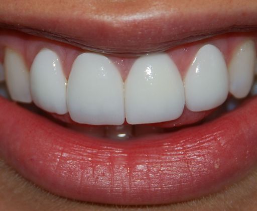 Dental Veneers Case 4 - After